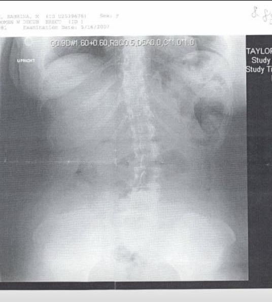 From Sabrina's Facebook: Photo of x-ray indicating spinal curve